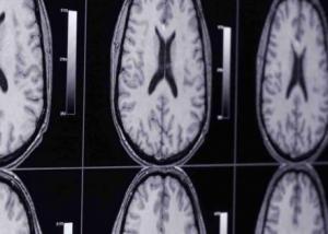 لموجات فوق الصوتية تفتح آفاقاً جديدة لعلاج أمراض المخ